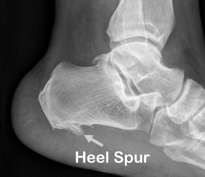 X-ray left foot showing heel spur